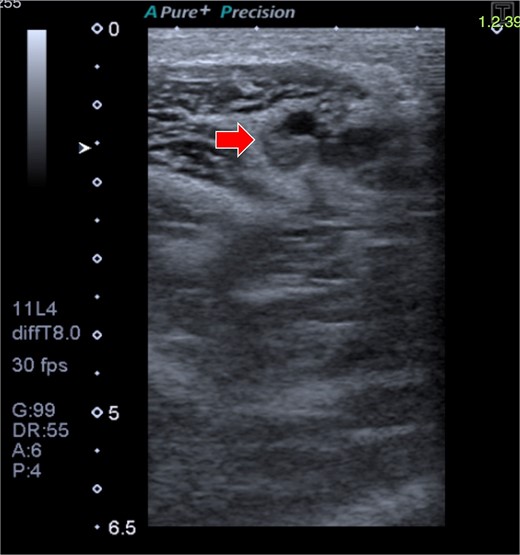 Doppler ultrasound shows DVT in the right axillary vein (arrow).