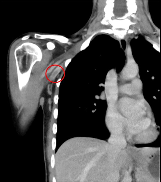 CT of the right upper extremity showing thrombosis of the right axillary and humeral veins (circle).