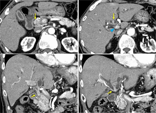 Preoperative contrast-enhanced computed tomography. Hilar bile duct thickening (arrows) and intrahepatic bile duct dilation are observed. The portal vein (arrowhead) is close to the thickened hilar bile duct.