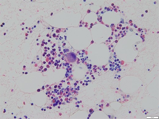 Bone marrow biopsy specimen (Naphthol AS-D chloroacetate esterase Giemsa staining, ×400). The myeloid/erythroblast ratio is normal, and the number of megakaryocytes is slightly increased without platelet adhesion.