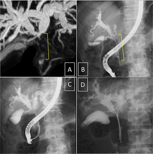 Cholangiography. Magnetic resonance imaging (A) and endoscopic retrograde cholangiopancreatography (B, D) reveal full circumferential stenosis in the mid-to-upper bile ducts without left and right bile disconnections. (C) The biopsy is conducted in the distal bile duct.