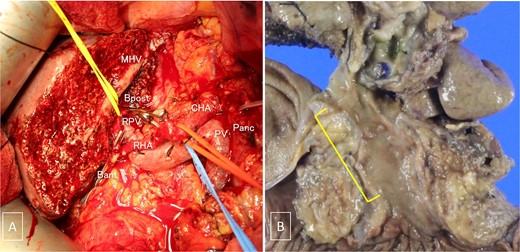 (A) Intraoperative photograph taken after tumor resection. (B) Gross examination of the resected specimen containing the tumor. MHV, the middle hepatic vein; Bpost, the right posterior branch of the bile duct; Bant, the anterior branch of the bile duct; PV, the portal vein; RPV, the right branch of the portal vein; CHA, the common hepatic artery; RHA, the right hepatic artery; Panc, pancreas.