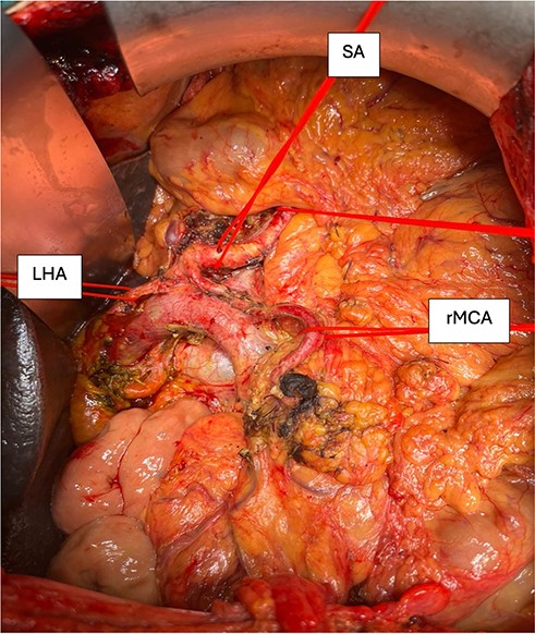 Image of the post-resection situs showing the coeliac trunk with its branches marked with vessel loops. SA, splenic artery; LHA, left hepatic artery; rMCA, replacing middle colic artery.
