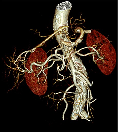 3D-reconstruction of the arterial branching pattern of the whole coeliac trunk and the superior mesenteric artery.