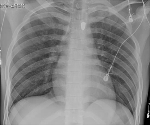 Trauma bay chest X-ray showing retained projectile.