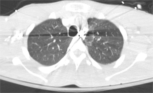 CT angiogram of chest showing retained projectile.