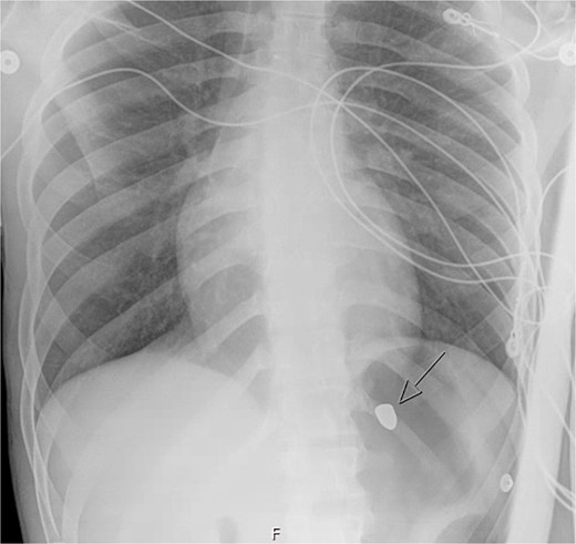 Hospital day 1 chest X-ray.
