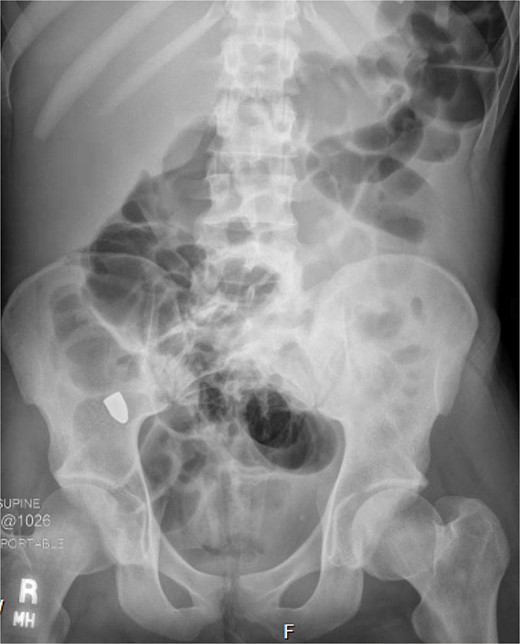 Retained projectile now at the cecum.