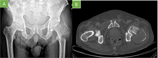 (A) X-ray pelvis AP view: geographic lytic insufflating expansive lesion centered in the intertrochanteric region of the left femur that destroys the cortex with poorly defined borders in certain locations. Soft tissue mass associated. The tumor matrix shows thin septum reaching 9 cm in longitudinal axis. (B) Axial CT: lytic lesion with cortical destruction at trochanteric level.