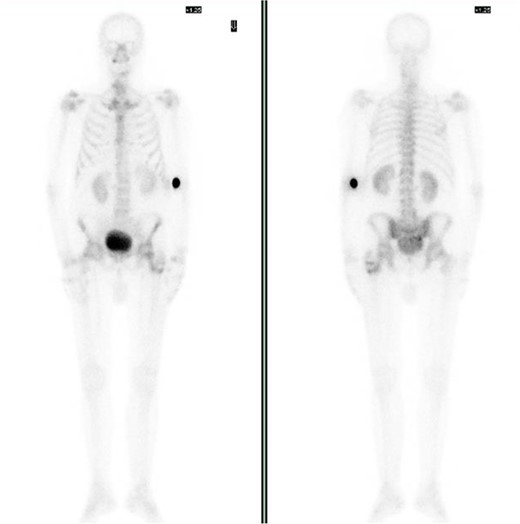 Bone scintigraphy of the entire skeleton with Tc99 and SPECT–CT. Highlighting of radioactive tracer in left proximal femur and sacrococcygeal region.