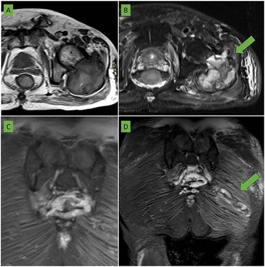 (A) T2 sequence with fat saturation and (B) T1-weighted sequence in axial plane centered on the left hip: a large expansive lesion is visualized centered in the trochanteric region extending to the femoral neck with a heterogeneous matrix of hyperintense predominance with respect to the muscle in both sequences in which cavities with liquid/liquid levels are identified (arrow) compatible with bleeding in different phases. The anterior cortex is focally rotated extending to the medial gluteal musculature (arrow). (C) Coronal section in STIR sequence showing sacrococcygeal involvement of the same characteristics as the femoral lesion. (D) Coronal section in STIR sequence centered in the gluteal region: an elongated lesion with lobulated borders is seen extending from the lateral region of the gluteus maximus to the proximity of the sacrococcygeal region (arrow). It coincides with the biopsy trajectory and is suggestive of tumor seeding.