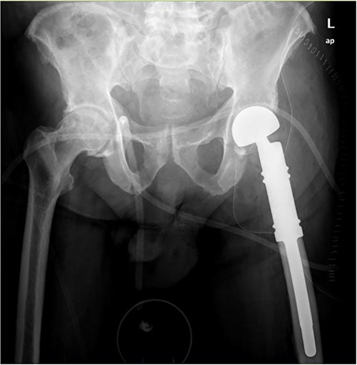 Wide intra-articular tumor resection of the proximal femur and reconstruction with tumor prosthesis and bipolar head.