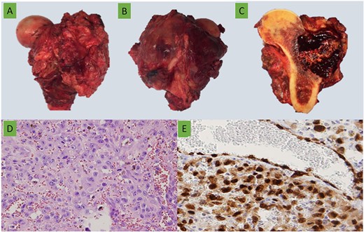 15 cm long of (A) anterior and (B) posterior gross views of the proximal femoral resection with a lateral soft tissue mass. (C) Lateral metaphysis-diaphyseal tumor with soft tissue extension, composed by bloody multiloculated cavities. (D) Epithelioid cells forming vascular channels with marked atypia (H&E ×400). (E) ERG (ERG ×400).