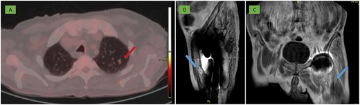 (A) PET-CT: 10 mm nodule in the left pulmonary apex with incipient metabolic activity suggestive of malignancy (arrow). (B, C) MRI: deep residual lesional focus in the anterolateral region dependent on the anterior rectus muscle (arrow).