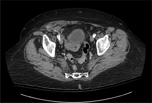 Axial view of contrast-enhanced computed tomography of the abdomen and pelvis demonstrating the right fallopian tube (F) attached to the uterus (U) extending into the Spigelian hernia defect containing the right ovary (O).