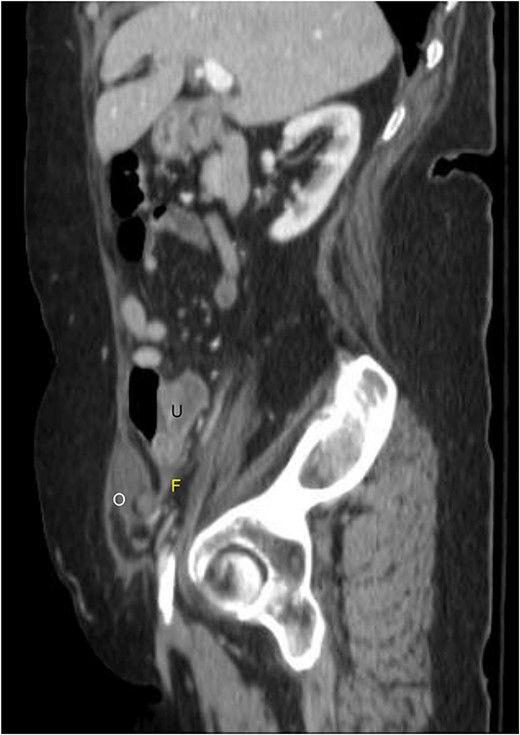 Sagittal view of contrast-enhanced computed tomography of the abdomen and pelvis demonstrating the right fallopian tube (F) attached to the uterus (U) extending into the Spigelian hernia defect containing the right ovary (O).