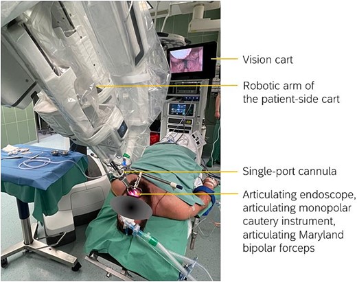 Configuration of the patient-side cart and the position of the robotic arm. The single-port cannula was aligned 10 cm above the opened mouth. One articulating endoscope and two articulating instruments were inserted into the single-port cannula: one monopolar cautery instrument, one Maryland bipolar forceps. The custom remote center was set approximately 2 cm in front of the maxillary teeth.