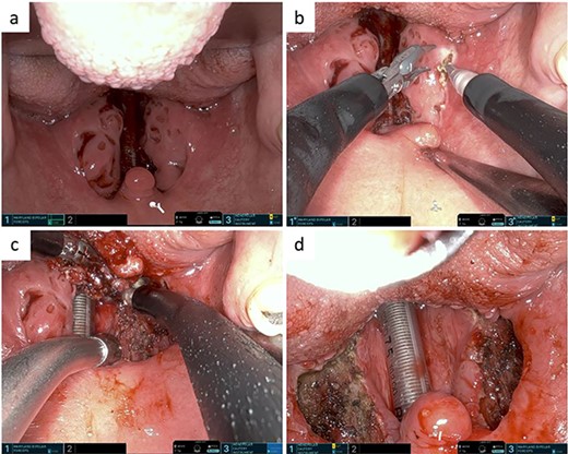 (a) Pre-tonsillectomy situs. (b) Medialization of the right tonsil using the Maryland bipolar forceps. Mucosal incision in the area of upper tonsil pole using the monopolar cautery instrument. (c) Dissection of the right tonsil along its capsule using the monopolar cautery instrument. (d) Post-tonsillectomy situs.