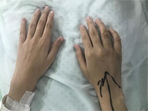 Preoperative photograph of hands showing swelling in fourth metacarpal of the right hand.