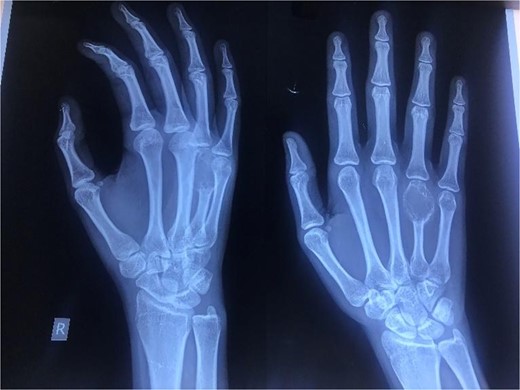 Oblique (left) and antero-posterior (right) view of the right hand revealing an expansile, lytic lesion with a soap bubble appearance over the entire fourth metacarpal bone with thinning of the cortex.