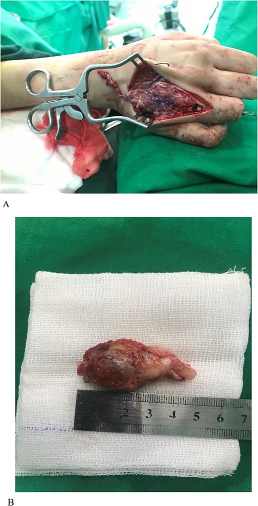 (A) GCT of the metacarpal. Note that the osteotomy of the proximal phalanx is visible in the picture. (B) Lesion excised. Both ends of the bone can be seen.