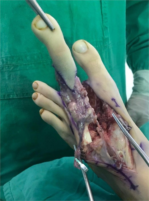 Harvested second toe can be seen.