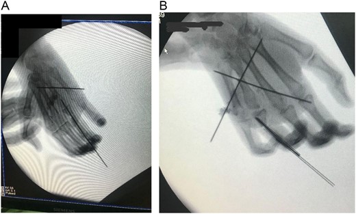 (A) Intraoperative X-ray showing K-wire inserted through the interphalangeal joint crossing the bone flap reaching up to the second metacarpal and another K wire inserted through the interphalangeal joints. (B) After fixation.