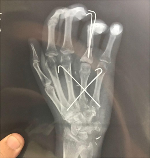 Post-operative X-ray at 3 weeks.