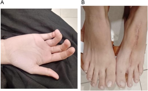 (A) Picture taken at 8 weeks postoperatively of the hand. (B) Picture taken at 8 weeks postoperatively of the donor site.