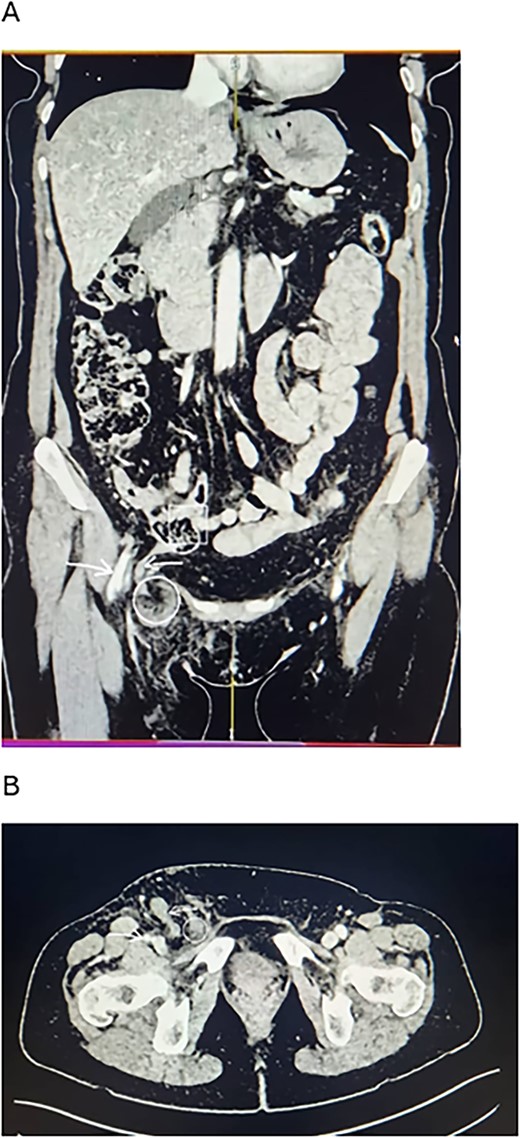 CT scan findings of the patient. (A) Coronal view. (B) Axial view. Note the long appendix (reverse arrow) extending from the ileocecal junction (squared area) into the femoral sac (circled area). There is stranding around the sac in the femoral canal. The femoral vessels (forward arrow) run beside the canal.