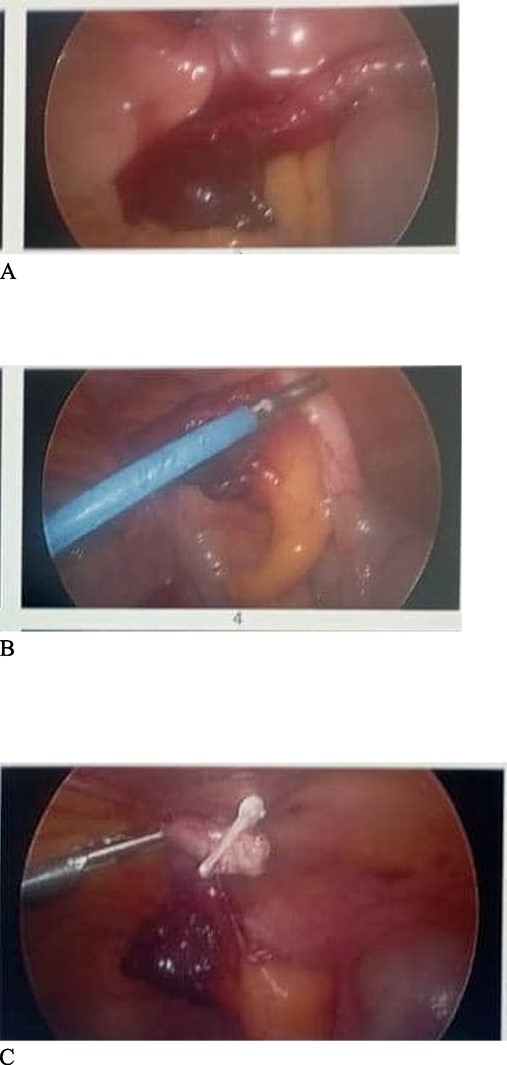 Findings at laparoscopy. (A) Distal end of the appendix herniating through the abdominal wall into the canal. (B) Appendix being pulled out of the abdominal wall defect. (C) Appendicectomy done after dissecting the mesoappendix and clipping the base of appendix with haemolock clips.