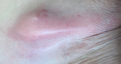Anterior abdominal wall abscess from colo-cutaneous fistula.