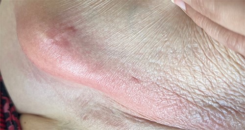 Anterior abdominal wall abscess from colo-cutaneous fistula.