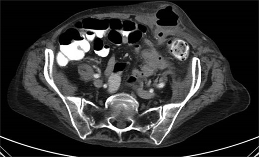 CT from readmission with anterior abdominal wall abscess and left pelvic abscess.