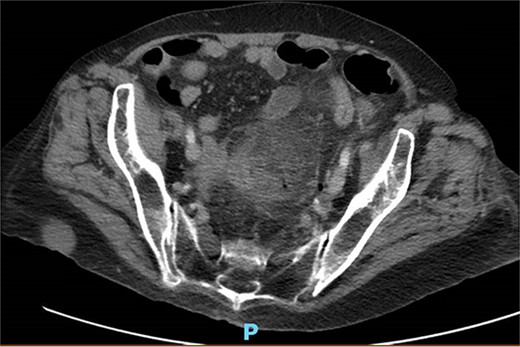 CT with perforation from prior admission.
