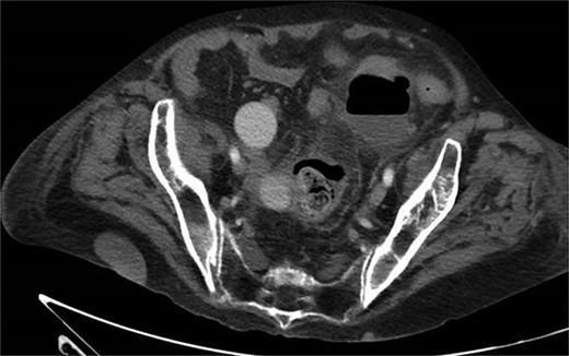 CT with abscess developed after initial antibiotic treatment.