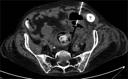 CT-guided percutaneous drainage of abscess.