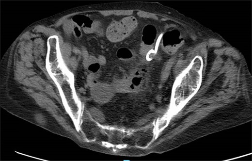 CT showing resolution of abscess with IR pigtail drain in place.