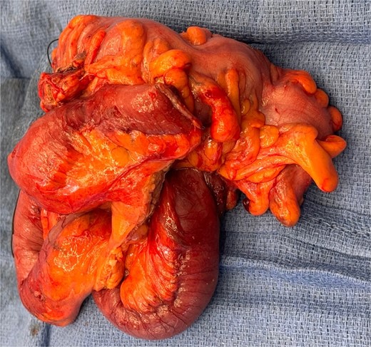 Intraoperative findings of colo-cutaneous fistula, sigmoid colon, and adhered small bowel.