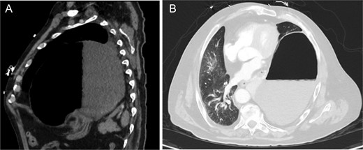 Pre-operative CT chest w/ contrast showing (A) large left Bochdalek hernia containing a large portion of distended stomach and (B) near-complete collapse of the left lower lobe with mediastinal shift.