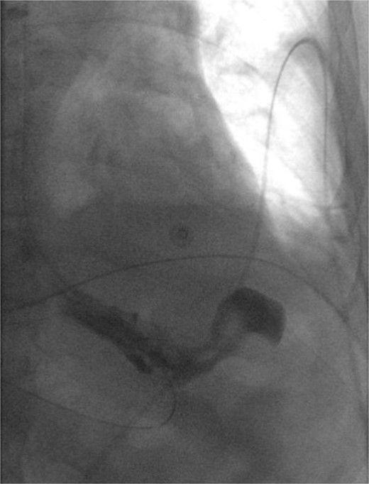Barium swallow status post left diaphragmatic hernia repair without evidence of leak or proximal obstruction.