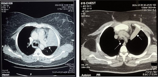 Left: Right main bronchus shown by black arrowhead and inflamed lung parenchyma shown by arrowhead. Right: Trachea and collapsed lung on CT scan (white arrowhead).