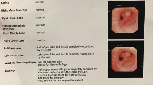 Bronchoscopy report confirming a mass completely occluding the left upper lobe and lingula (Fig. 3). Endobronchial lipoma along the left main bronchus (white arrowhead).