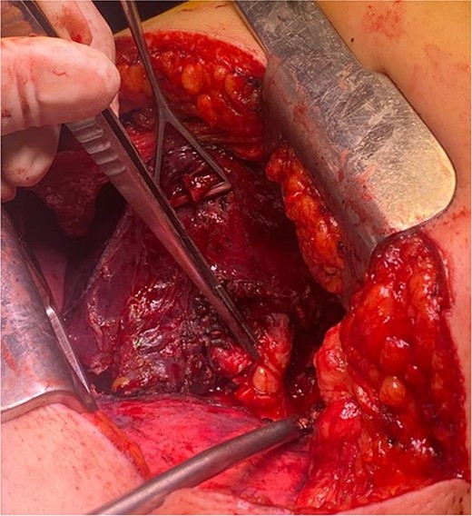 Endobronchial lipoma along the left main bronchus (arrowhead).