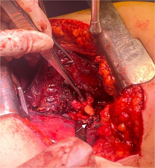Endobronchial lipoma along the left main bronchus (arrowhead).