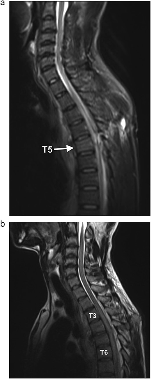 (a) Sagittal STIR MR shows a hyperintense signal along the dorsal mid-thoracic soft tissue wound tract, extending into the spinal canal with T5 level cord disruption and T5 vertebral body marrow oedema. (b) Sagittal T2WI MR demonstrates cord oedema as a hyperintense signal of the central cord (T3 to T6 level).