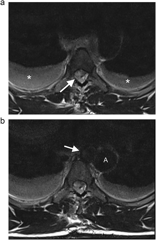 (a) Axial T2WI MR at the midthoracic level demonstrates an epidural hematoma in the right lateral spinal canal with compression of the cord (arrow) and bilateral hydrothoraces (*). (b) Axial T2WI MR shows a round lesion (arrow) inseparable from the medial aspect of the mid-thoracic aorta (A), with an isointense signal to the thoracic aorta.