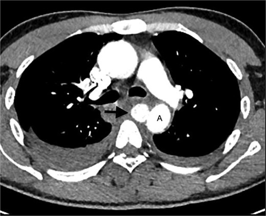 CT angiogram of the chest confirms a pseudoaneurysm (arrow) of the thoracic aorta (A), with surrounding mediastinal haematoma and bilateral haemothoraces.