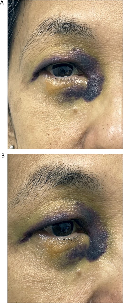 Front (A) and oblique (B) views of right eye of Case 1 showing severe periorbital ecchymosis 3 days after receiving acupuncture therapy for dry eye.