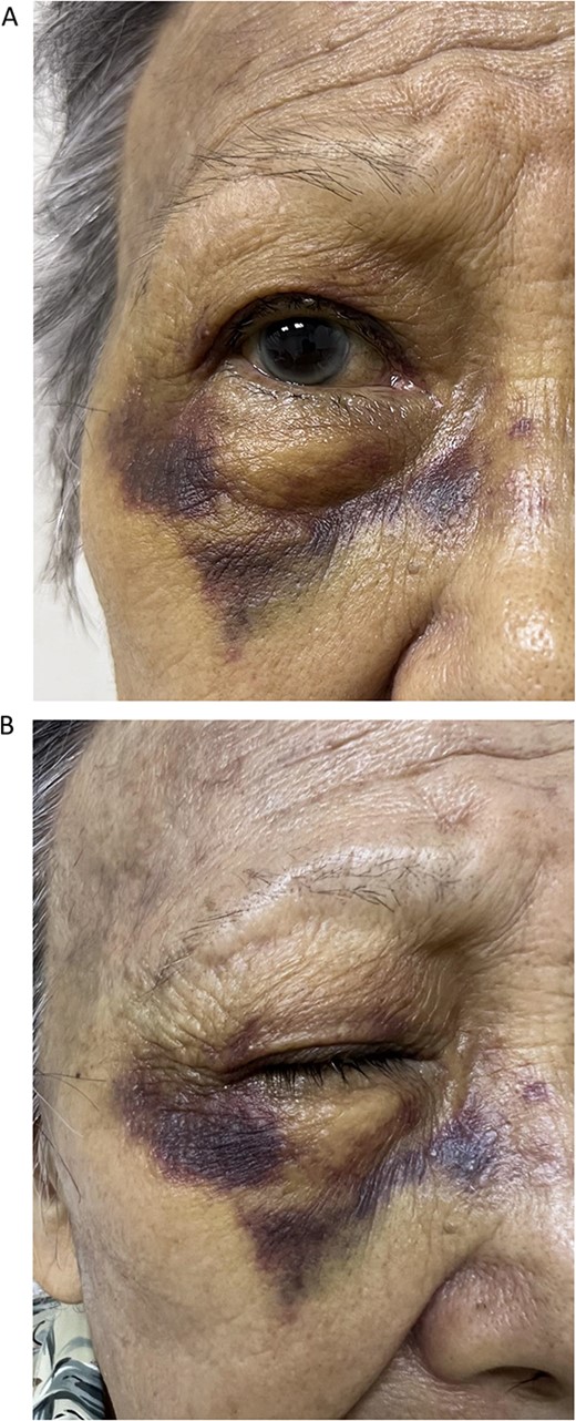 Front (A) and oblique (B) views of right eye of Case 2 showing severe periorbital ecchymosis 10 days after receiving acupuncture therapy for dry eye.